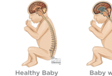 Baby:6ljdk4wj_Gu= Hydrocephalus