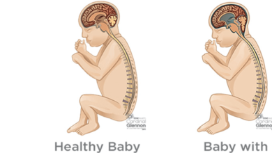 Baby:6ljdk4wj_Gu= Hydrocephalus